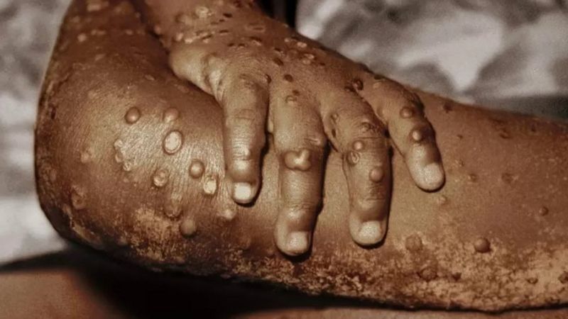 मंकीपक्स, विश्वव्यापी स्वास्थ्य आपत्काल घोषणा