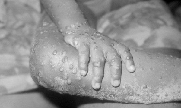 विश्वव्याी रुपमा मंकीपकस संक्रमितको&hellip;
