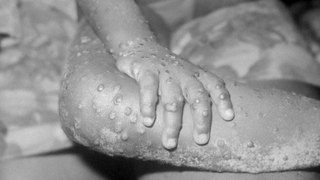 विश्वव्याी रुपमा मंकीपकस संक्रमितको संख्या&hellip;