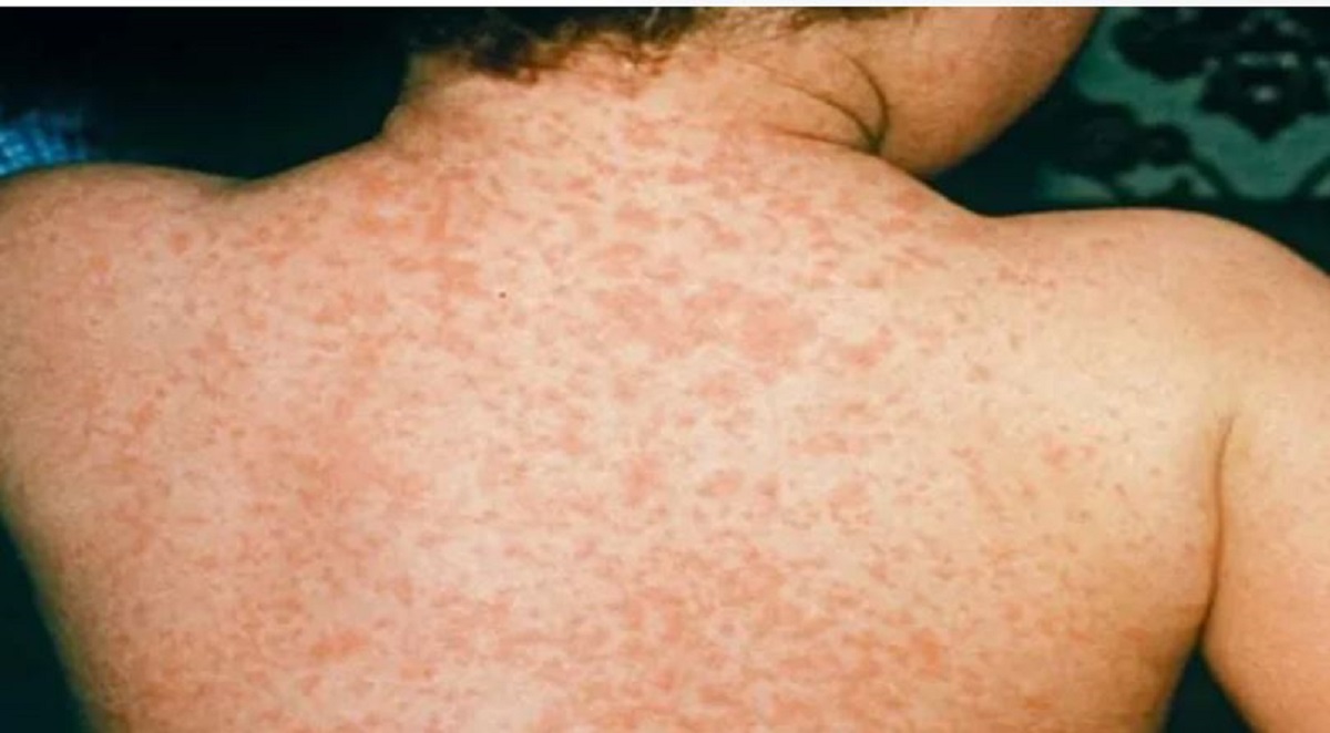 बाँकेमा दादुराको सङ्क्रमण कायमै, तीन सय नौ बालबालिका सङ्क्रमित